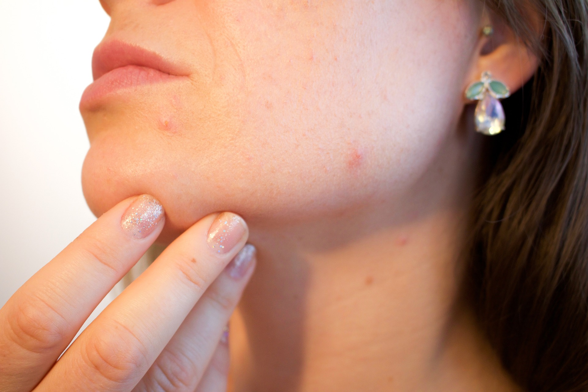 https://pixabay.com/it/photos/acne-pori-pelle-brufolo-femmina-1606765/