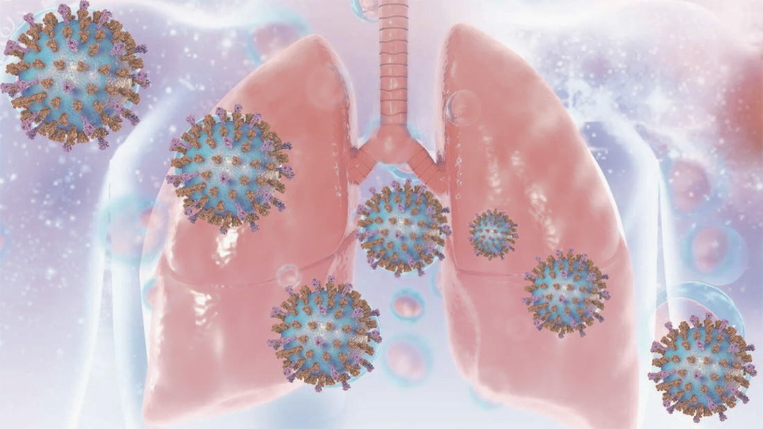 Virus respiratorio sinciziale